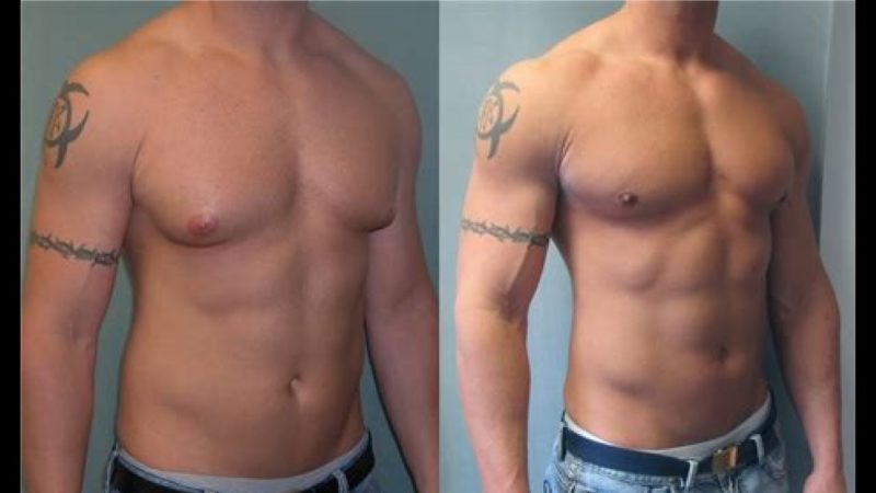 gynecomastia doctor in Punjab