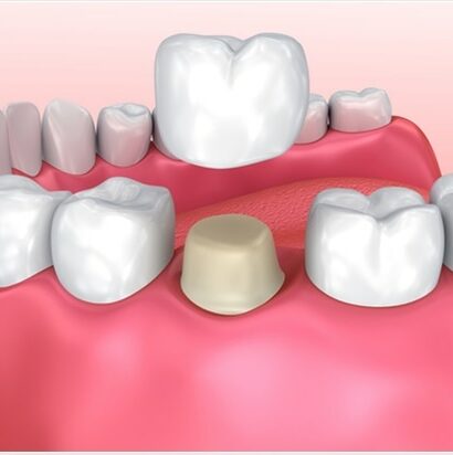 Understanding Dental Crowns How They Work