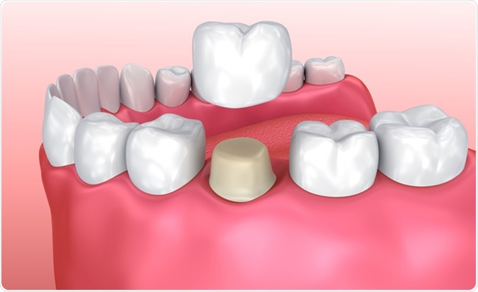 Understanding Dental Crowns How They Work